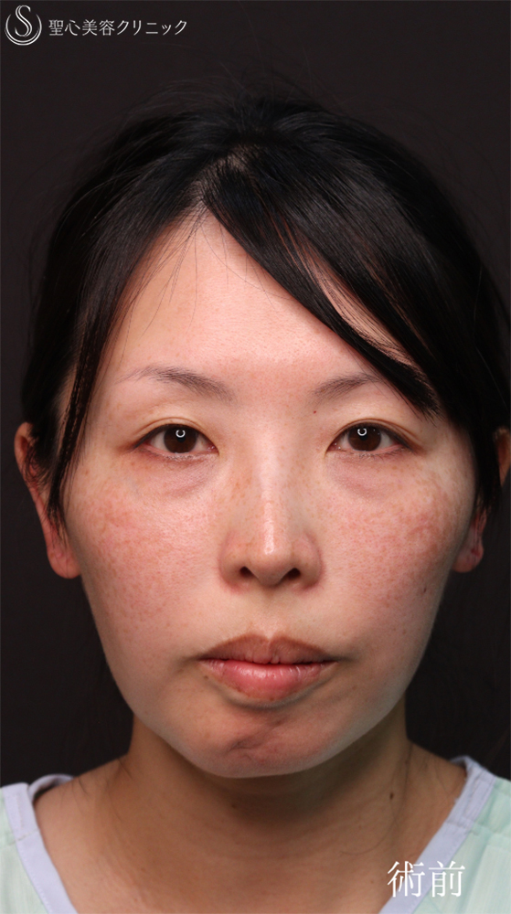 【40代女性・皮膚を切らずにクマ治療】裏ハムラ法（1ヶ月後） Before 