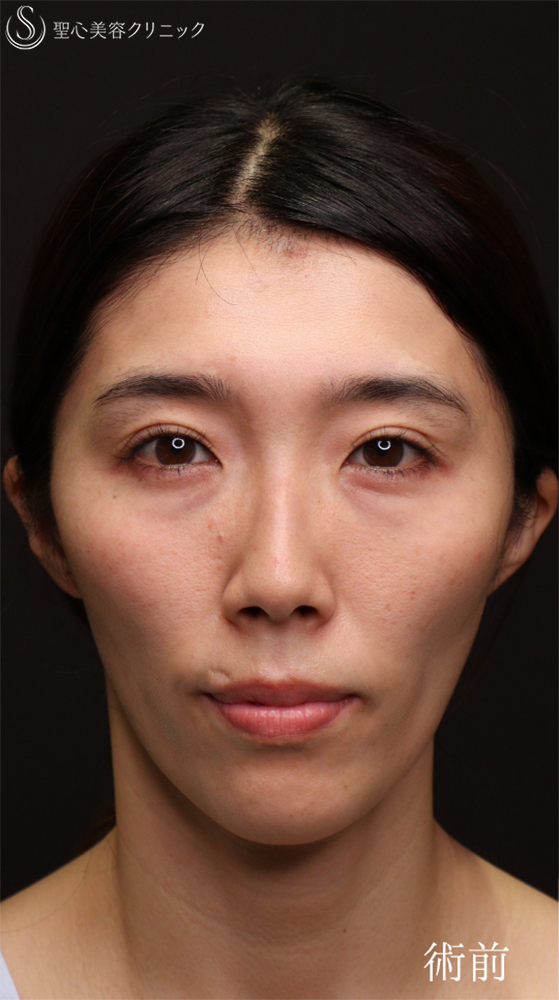 【30代女性・目の下の疲れ見え改善】裏ハムラ（1ヶ月後） Before 