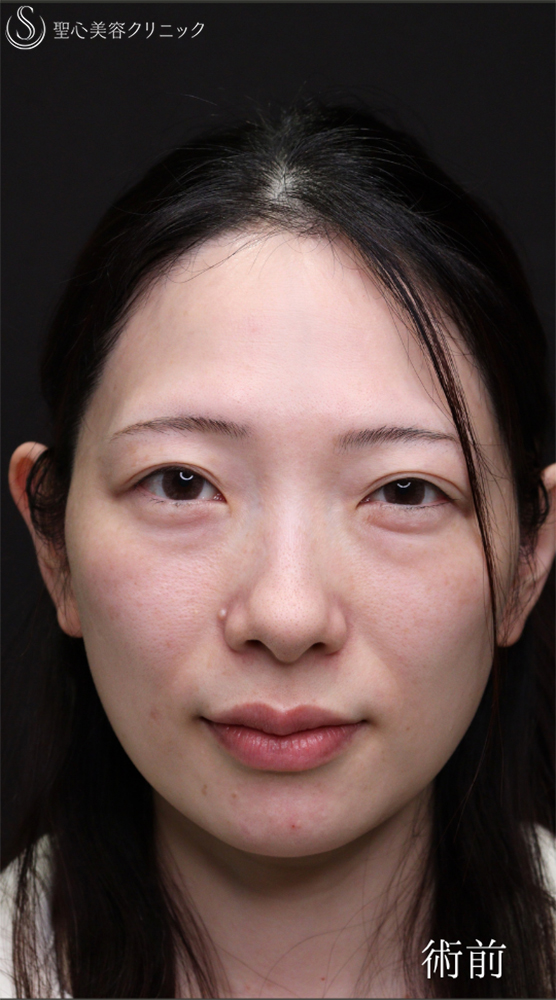 【30代女性・傷のないクマ治療】裏ハムラ（1ヶ月後） Before 