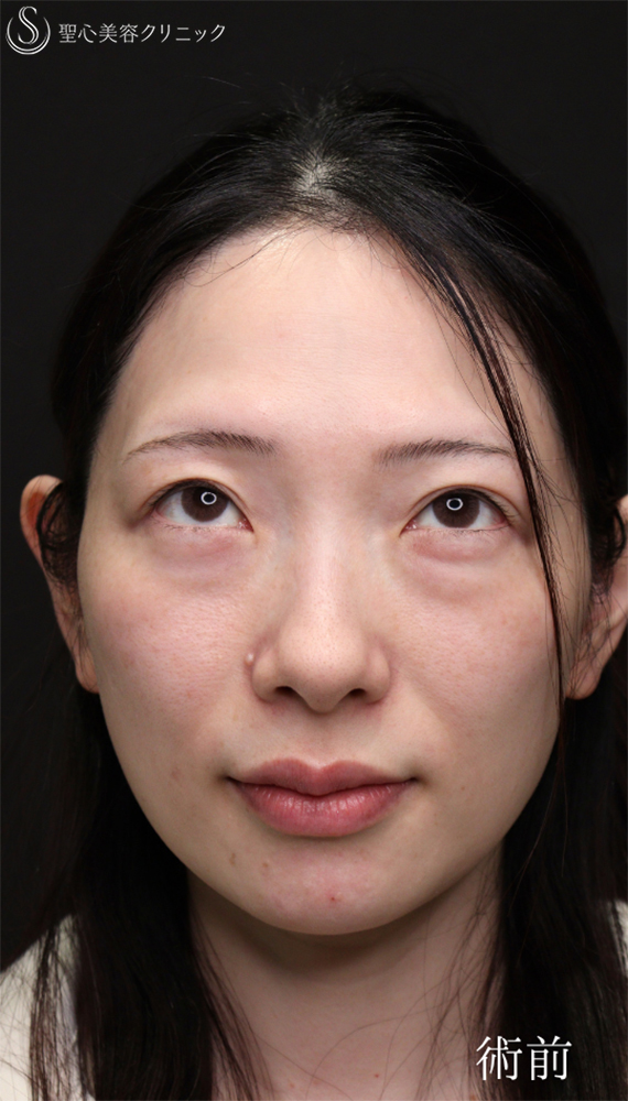 【30代女性・傷のないクマ治療】裏ハムラ（1ヶ月後） Before 