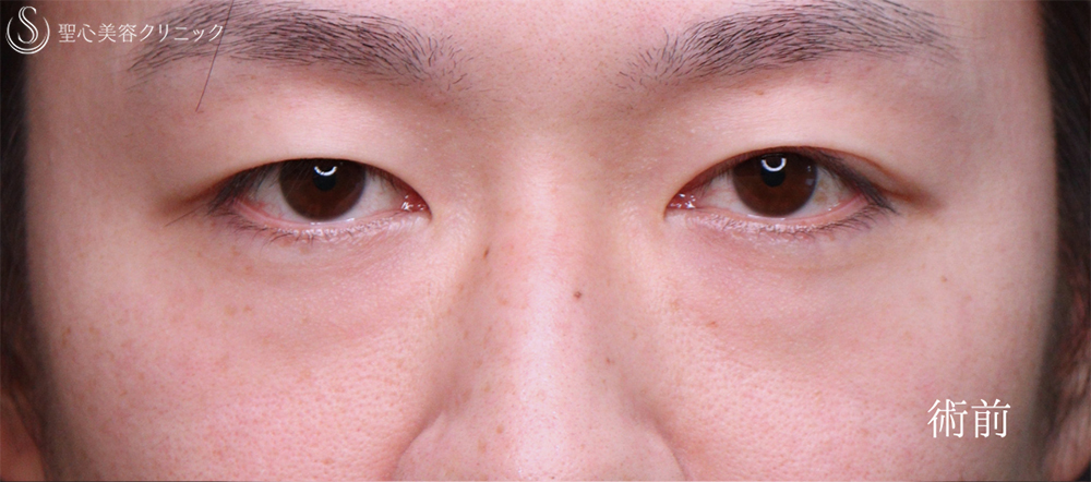 【30代男性・自然なクマ治療】裏ハムラ（1ヶ月後） Before 
