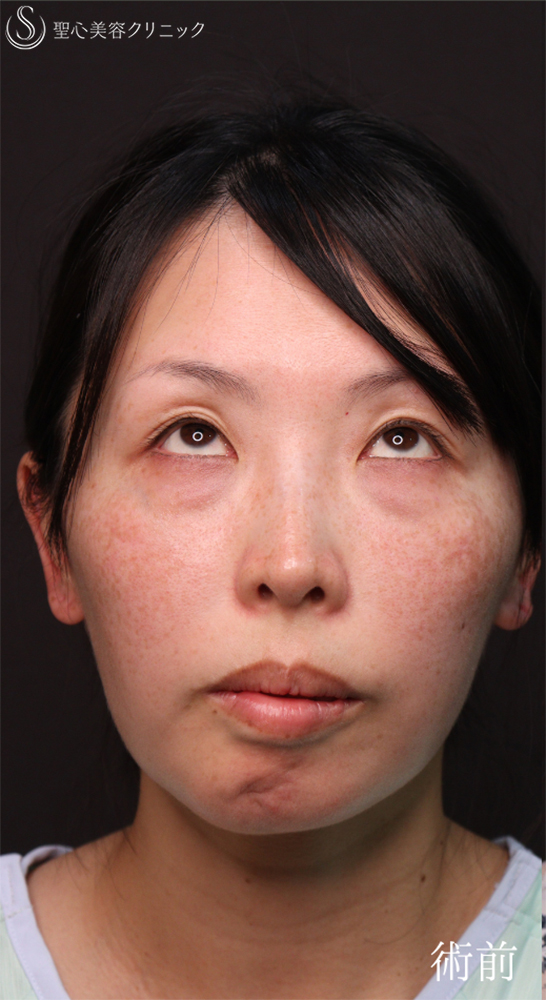 【40代女性・皮膚を切らずにクマ治療】裏ハムラ法（1ヶ月後） Before 
