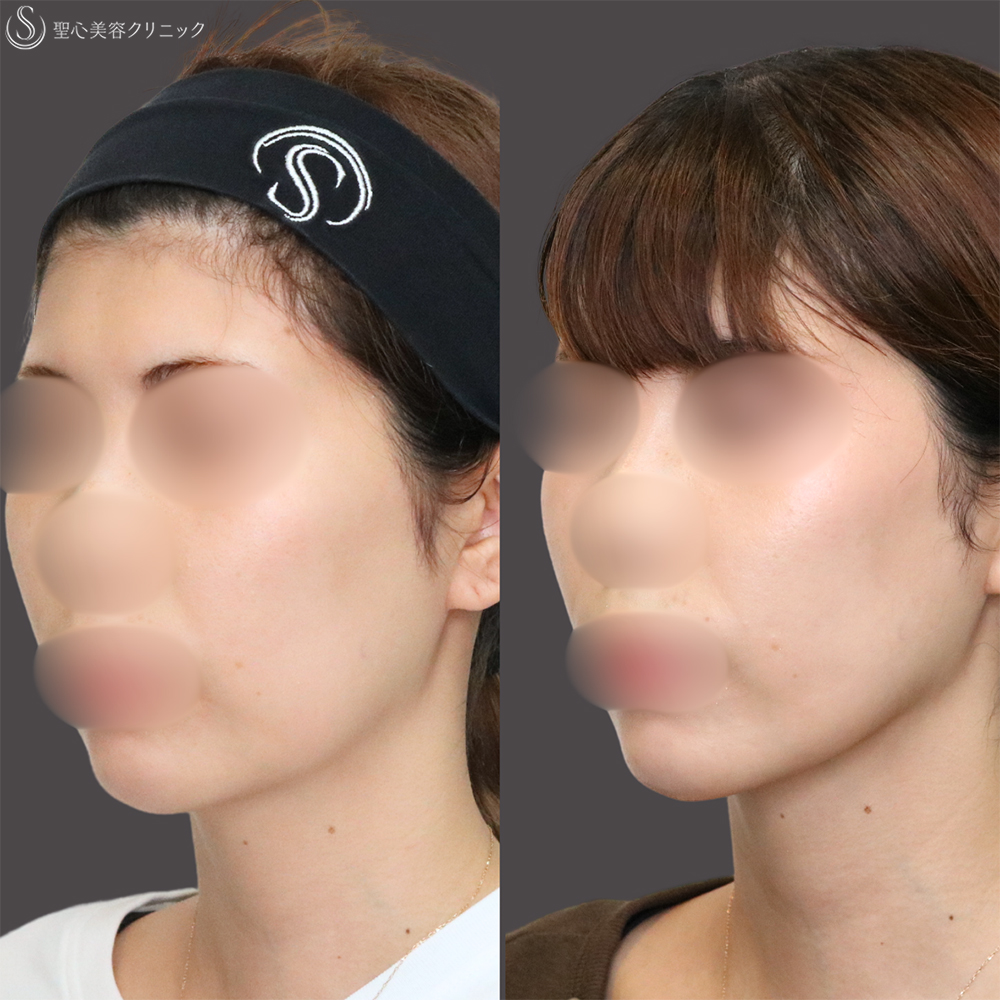 【30代女性・顎下もすっきり】脂肪吸引注射（頬＋顎）（1ヶ月後） After 名古屋　小顔　脂肪吸引　フェイスライン
