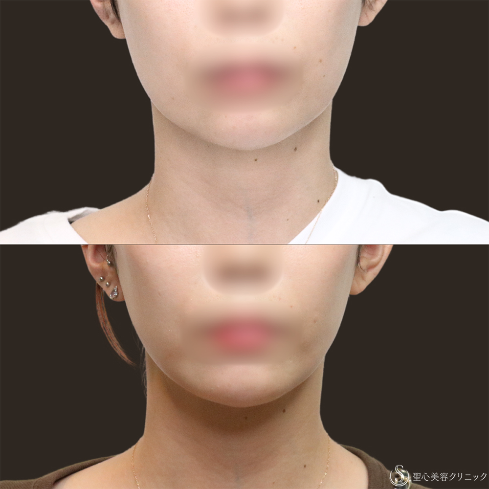 【30代女性・顎下もすっきり】脂肪吸引注射（頬＋顎）（1ヶ月後） After 名古屋　小顔　脂肪吸引　フェイスライン
