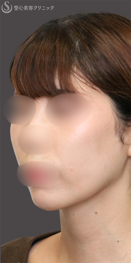 【30代女性・顎下もすっきり】脂肪吸引注射（頬＋顎）（1ヶ月後） After 