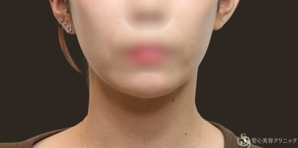 【30代女性・顎下もすっきり】脂肪吸引注射（頬＋顎）（1ヶ月後） After 