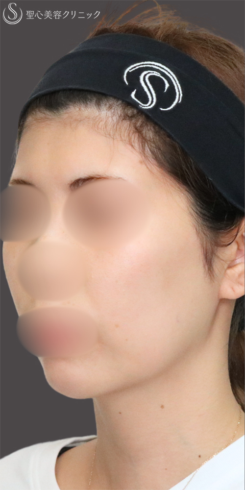【30代女性・顎下もすっきり】脂肪吸引注射（頬＋顎）（1ヶ月後） Before 