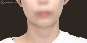 エラ張りの悩みを解決！専門家が教える原因と効果的な方法【エラ張り