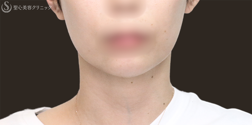【30代女性・顎下もすっきり】脂肪吸引注射（頬＋顎）（1ヶ月後） Before 