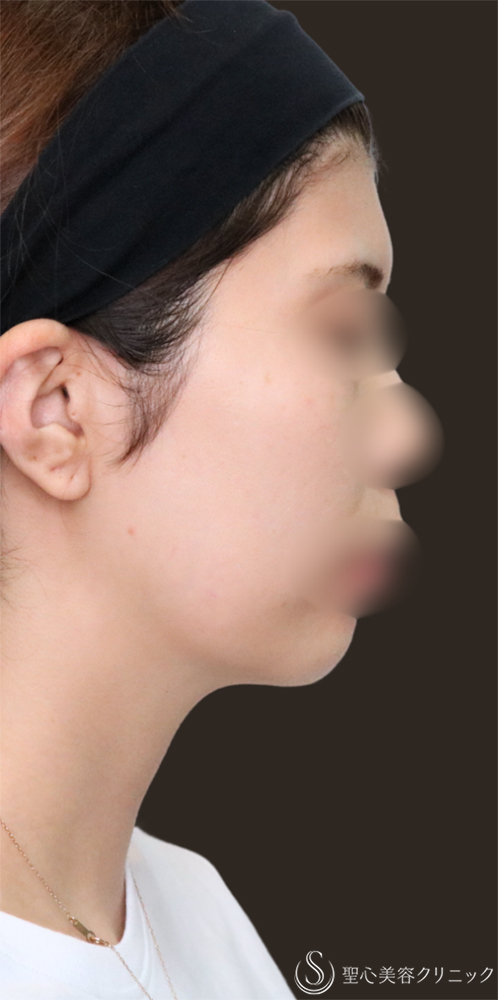 【30代女性・顎下もすっきり】脂肪吸引注射（頬＋顎）（1ヶ月後） Before 