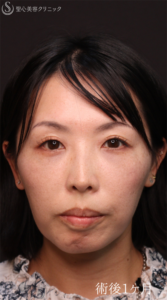 【40代女性・皮膚を切らずにクマ治療】裏ハムラ法（1ヶ月後） After 