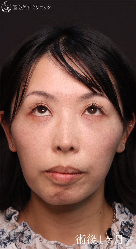 【40代女性・皮膚を切らずにクマ治療】裏ハムラ法（1ヶ月後） After 