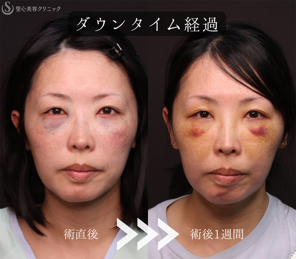 【40代女性・皮膚を切らずにクマ治療】裏ハムラ法（1ヶ月後） After 