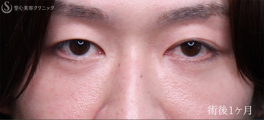 【30代男性・自然なクマ治療】裏ハムラ（1ヶ月後） After 