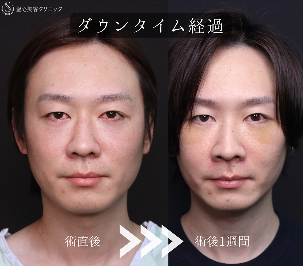 【30代男性・自然なクマ治療】裏ハムラ（1ヶ月後） After 