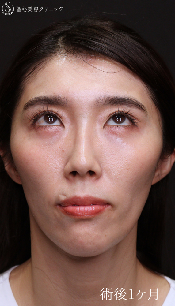 【30代女性・目の下の疲れ見え改善】裏ハムラ（1ヶ月後） After 