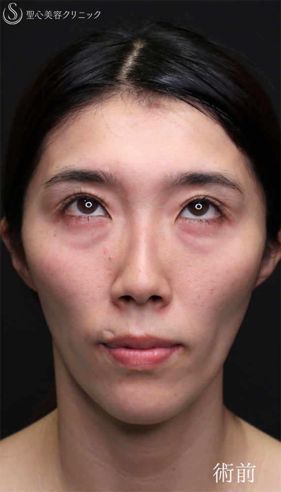 【30代女性・目の下の疲れ見え改善】裏ハムラ（1ヶ月後） Before 