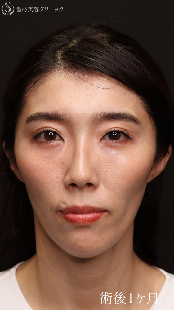 【30代女性・目の下の疲れ見え改善】裏ハムラ（1ヶ月後） After 