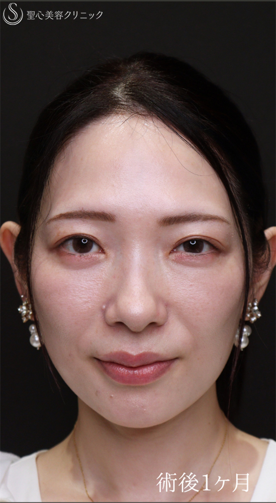 【30代女性・傷のないクマ治療】裏ハムラ（1ヶ月後） After 