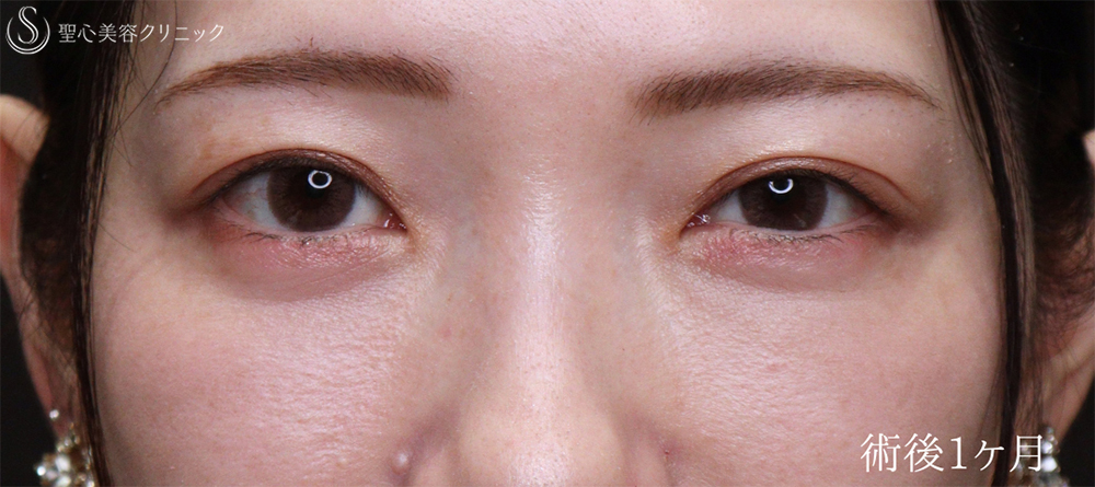 【30代女性・傷のないクマ治療】裏ハムラ（1ヶ月後） After 