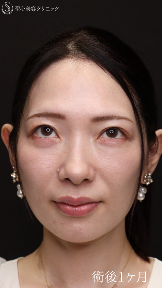 【30代女性・傷のないクマ治療】裏ハムラ（1ヶ月後） After 