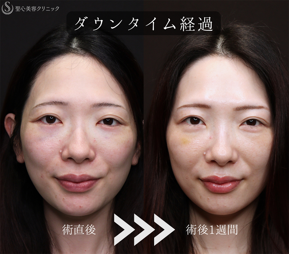 【30代女性・傷のないクマ治療】裏ハムラ（1ヶ月後） After 