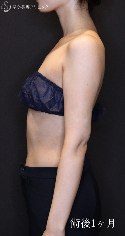【30代女性・すらっとした二の腕に】脂肪吸引（上腕）（1ヶ月後） After 