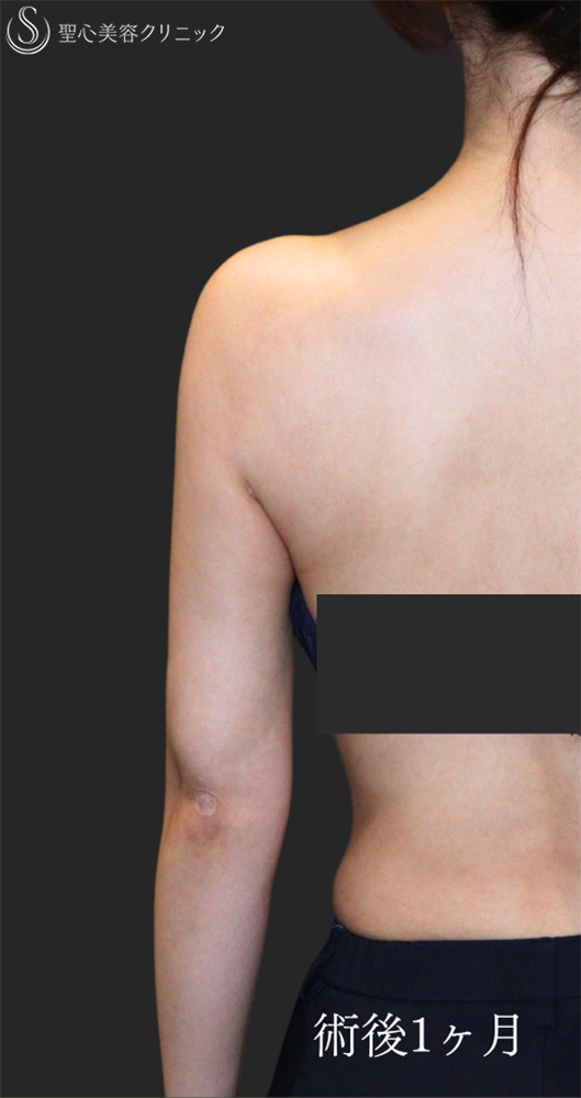 【30代女性・すらっとした二の腕に】脂肪吸引（上腕）（1ヶ月後） After 