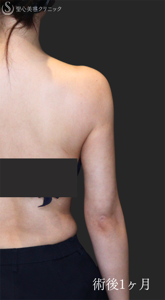 【30代女性・すらっとした二の腕に】脂肪吸引（上腕）（1ヶ月後） After 