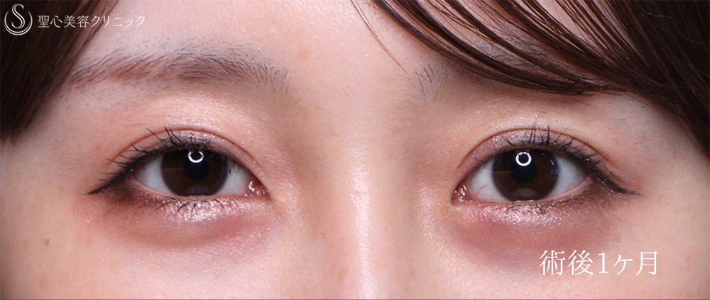 【20代女性・自然な平行二重に】二重切開（1ヶ月後） After 