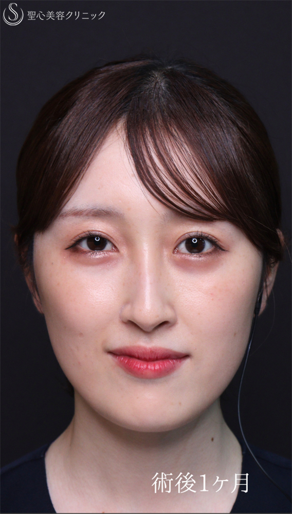 【20代女性・自然な平行二重に】二重切開（1ヶ月後） After 