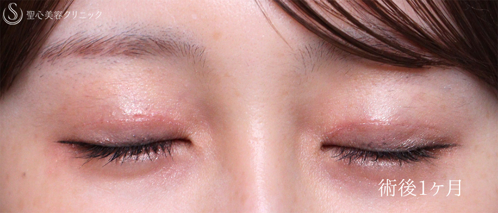 【20代女性・自然な平行二重に】二重切開（1ヶ月後） After 