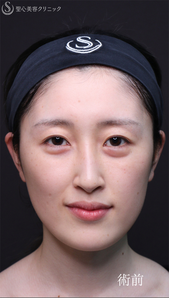 【20代女性・自然な平行二重に】二重切開（1ヶ月後） Before 