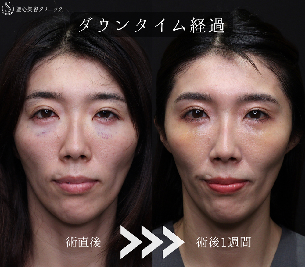 【30代女性・目の下の疲れ見え改善】裏ハムラ（1ヶ月後） After 