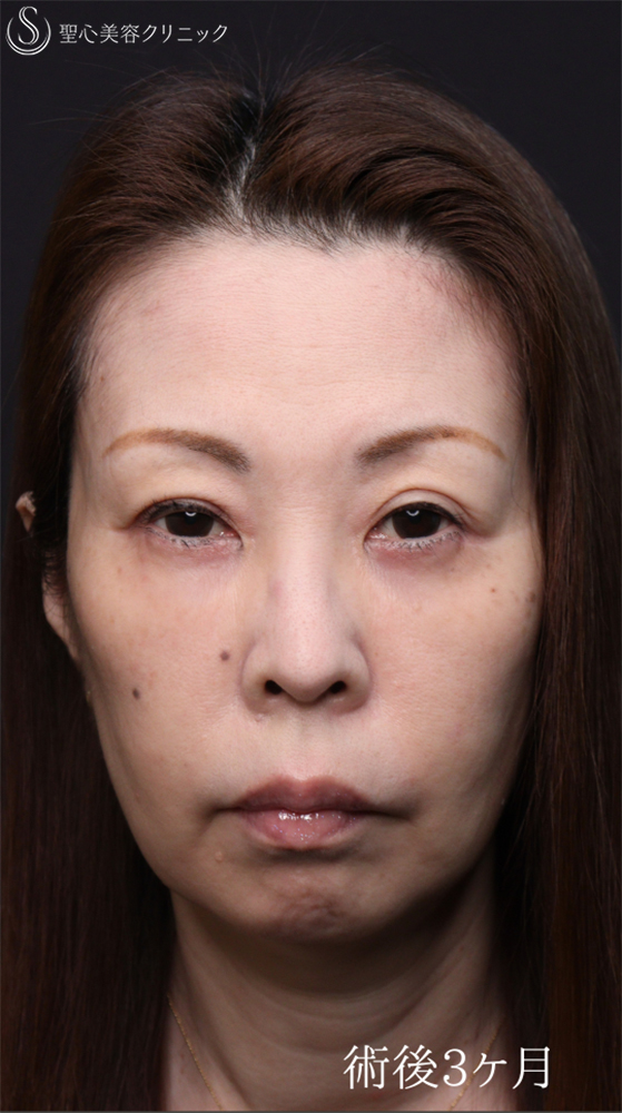 【50代女性・クマ治療で劇的な若返り】ハムラ法＋ミッドチークリフト（直後～3ヶ月後） After 