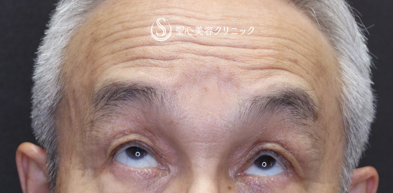 【70代男性・目の開きの左右差を改善】眼瞼下垂手術（左目のみ）（術後1ヶ月） After 