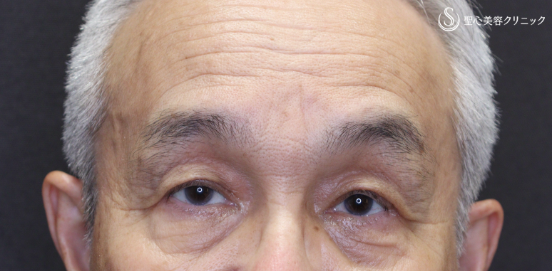 【70代男性・目の開きの左右差を改善】眼瞼下垂手術（左目のみ）（術後1ヶ月） After 