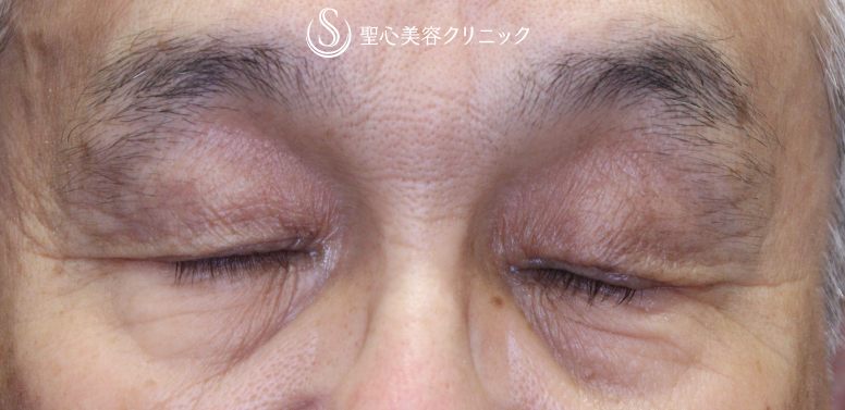 【70代男性・目の開きの左右差を改善】眼瞼下垂手術（左目のみ）（術後1ヶ月） After 