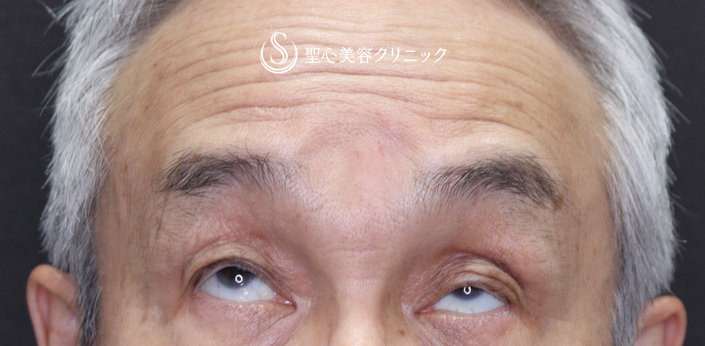 【70代男性・目の開きの左右差を改善】眼瞼下垂手術（左目のみ）（術後1ヶ月） Before 
