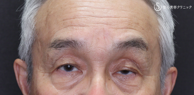 【70代男性・目の開きの左右差を改善】眼瞼下垂手術（左目のみ）（術後1ヶ月） Before 
