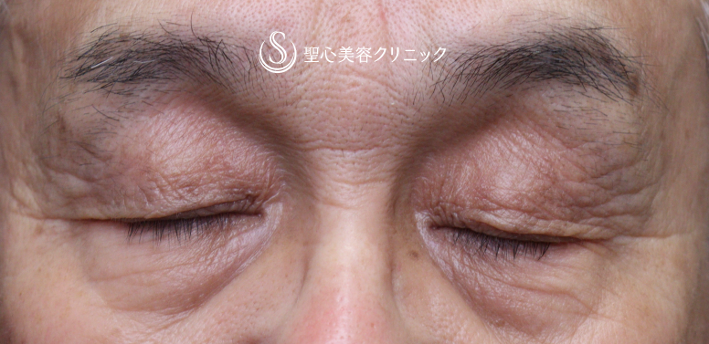 【70代男性・目の開きの左右差を改善】眼瞼下垂手術（左目のみ）（術後1ヶ月） Before 