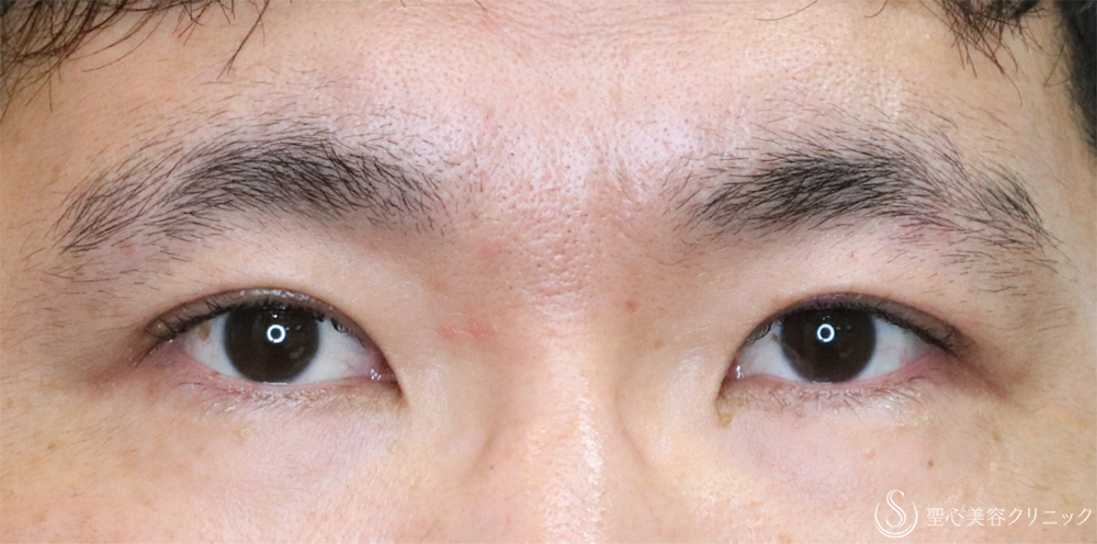 【30代男性・自然な二重に】二重全切開術＋脂肪除去（3ヶ月後） After 名古屋・脱脂・二重・ぱっちり二重・二重切開