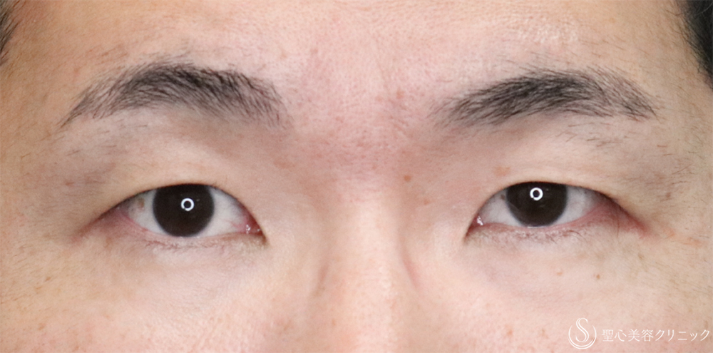 【30代男性・自然な二重に】二重全切開術＋脂肪除去（3ヶ月後） Before 