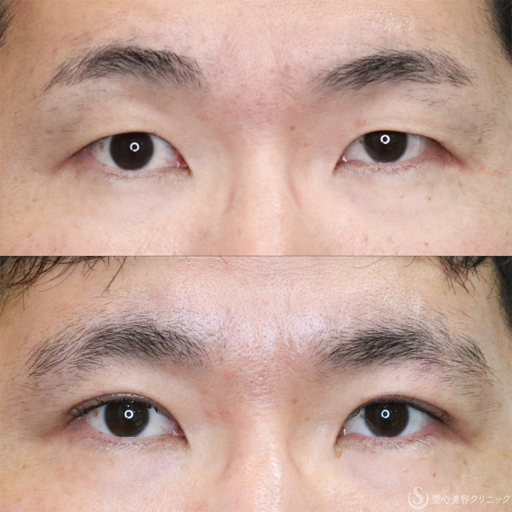 【30代男性・自然な二重に】二重全切開術＋脂肪除去（3ヶ月後） After 名古屋・脱脂・二重・ぱっちり二重・二重切開