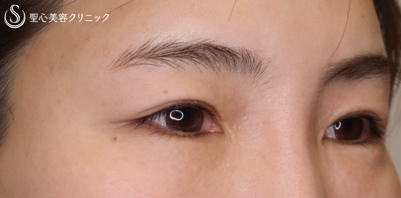 【40代女性・何年経過しても美しい目元】眉下切開（3年後） Before 