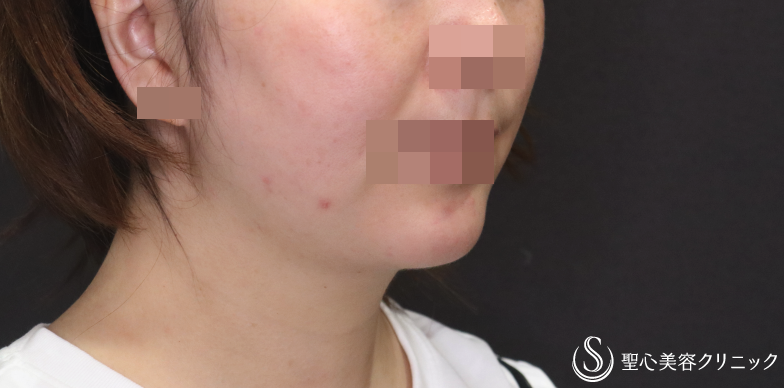 【30代女性・顎周りをスッキリ】ベイザー脂肪吸引（1ヶ月後） After 