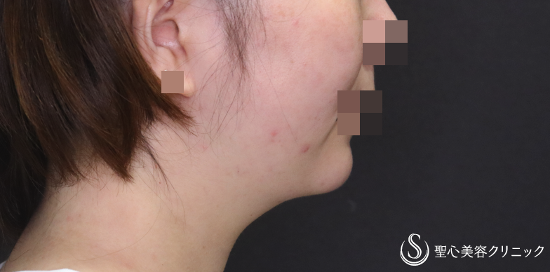 【30代女性・顎周りをスッキリ】ベイザー脂肪吸引（1ヶ月後） After 