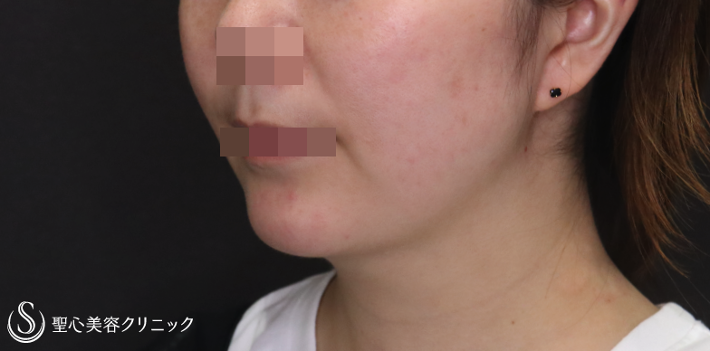 【30代女性・顎周りをスッキリ】ベイザー脂肪吸引（1ヶ月後） After 