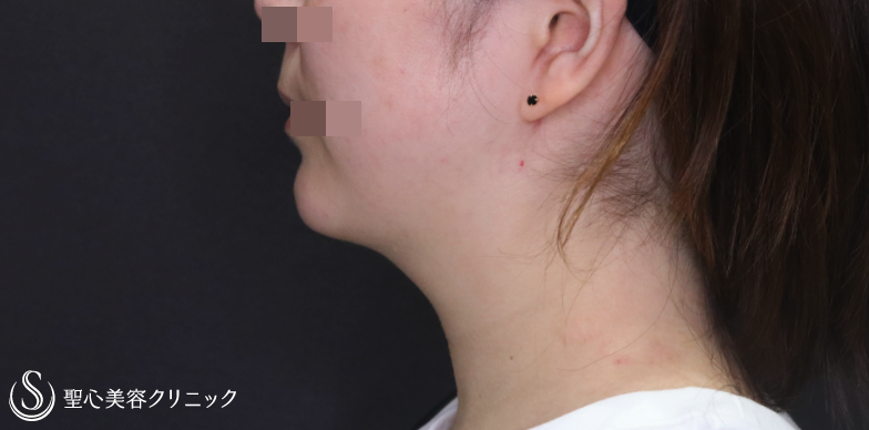 【30代女性・顎周りをスッキリ】ベイザー脂肪吸引（1ヶ月後） After 