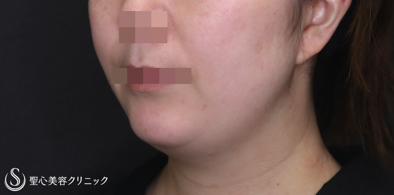 【30代女性・顎周りをスッキリ】ベイザー脂肪吸引（1ヶ月後） Before 